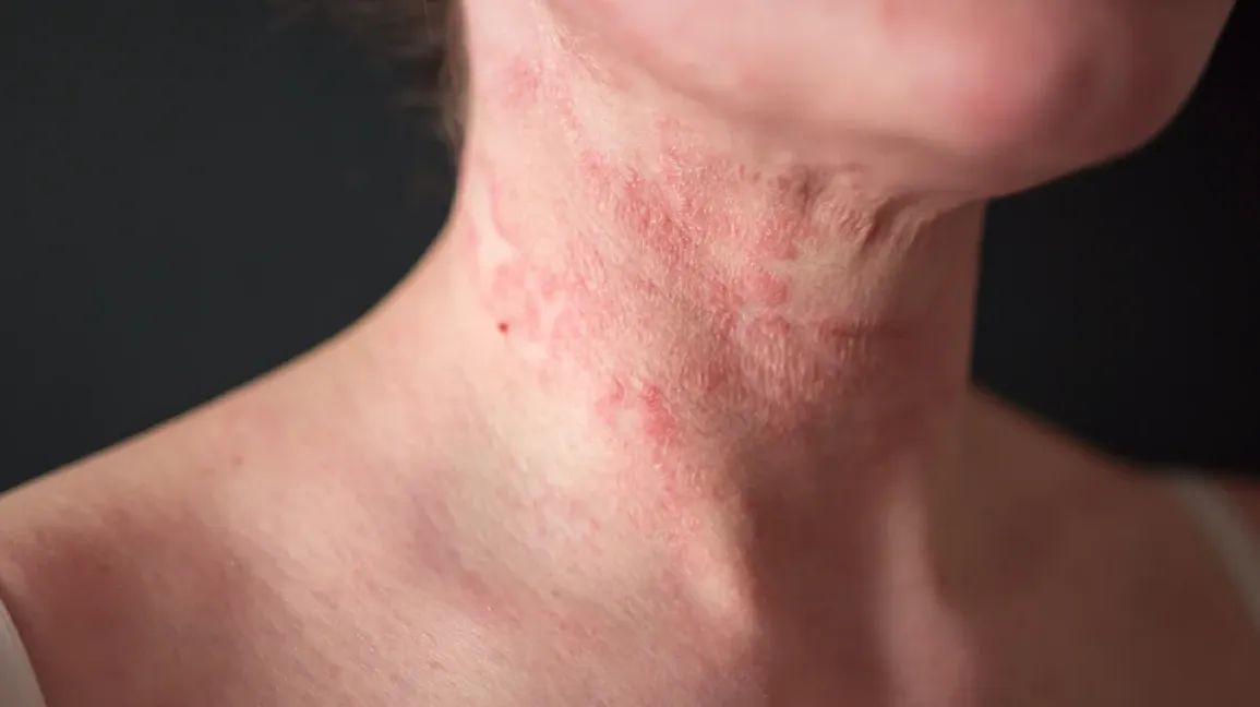Common Skin Diseases in Older Adults: Symptoms, Causes, and Treatment